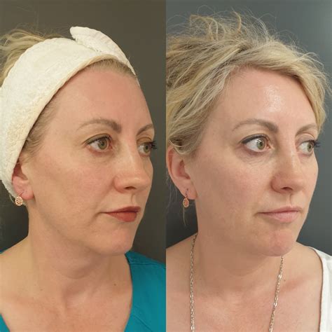 Dermal Aesthetics - Before and After Pictures
