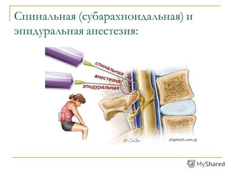 Презентация на тему: "Спинальная и эпидуральная анестезия. Анатомия ...