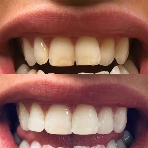 Teeth Whitening Belfast | Dr Olivia Clinics