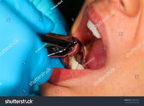 Close Dental Extraction Clinic Stock Photo (Edit Now) 254010274