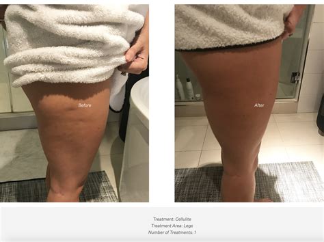 REJUV — Before & After Photos CryoSlimming & CryoToning CryoSkin ...