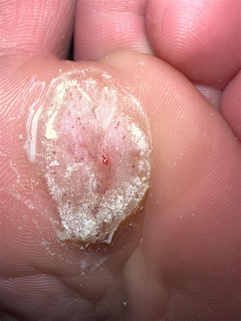 what do i do? stubborn warts : r/Warts