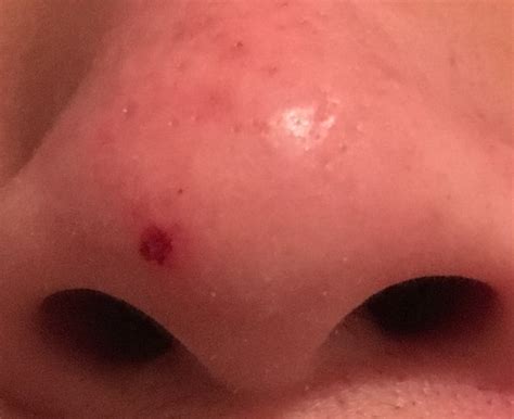 pop  whiteheads   big scab skin picking