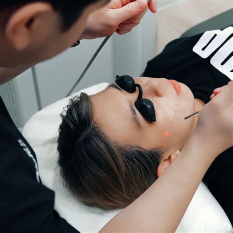 Acne Laser Treatment in Singapore @ $38 Nett