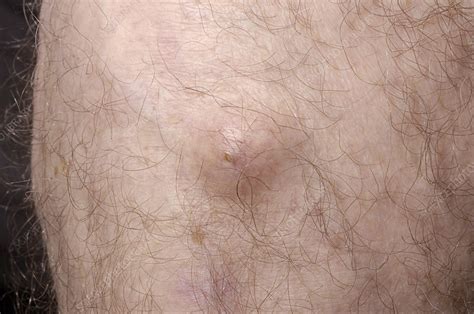 Sebaceous Cyst