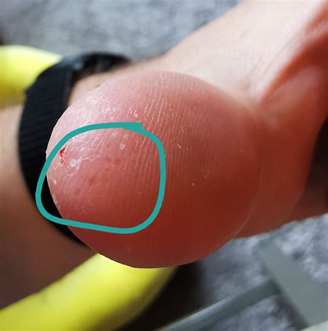 (M/34/No history of skin conditions aside from eczema) Small dark