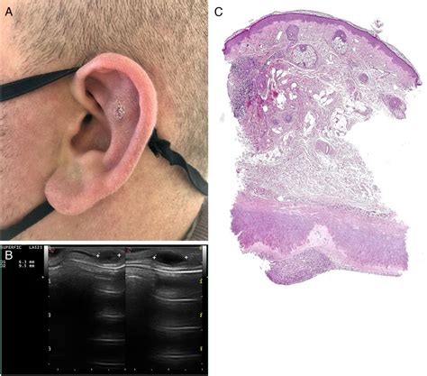 Celulitis Auricular