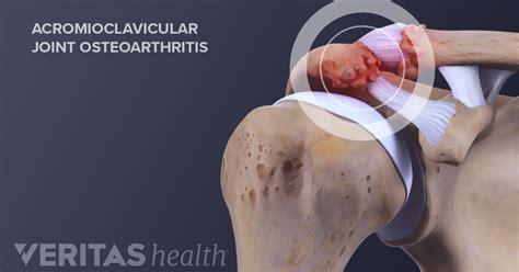 What is Acromioclavicular Arthritis (AC Joint Arthritis)? | Arthritis ...