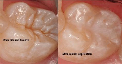 fissure sealants dentist haverhill