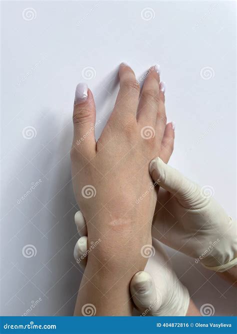 Postoperative Suture. Treatment Of Dislocation Of The Acromial End Of