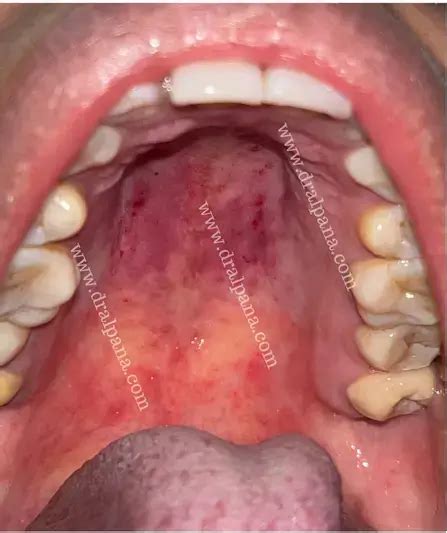 Palatal Petechiae: Causes, Diagnosis, and Treatment