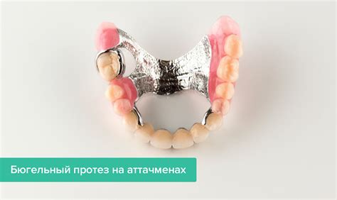 Аттачмены для протезов – что это такое, виды, фото