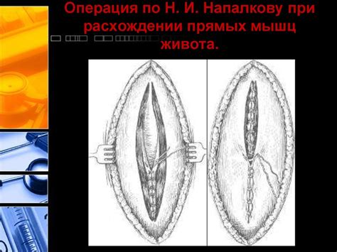 Послеоперационные вентральные грыжи - презентация онлайн