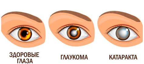 Катаракта и глаукома различия: в чем разница между патологиями, что ...