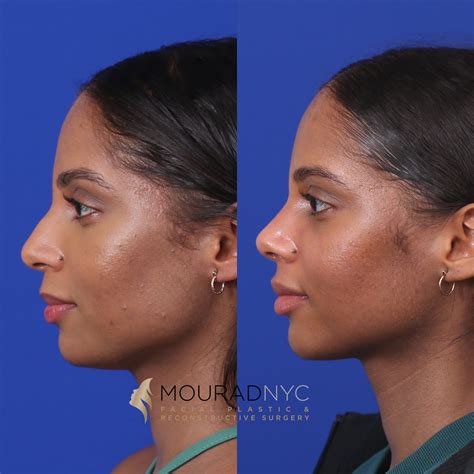 Before and After Female Closed Rhinoplasty | Facial Plastic Surgeon