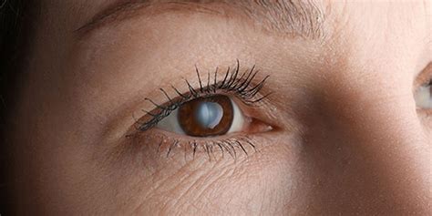 What are Cataracts and How are they Treated? - SA Eye Specialists ...