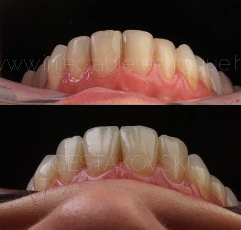 [ALL YOU CAN WATCH] Composite Veneers Masterclass + Full Mouth
