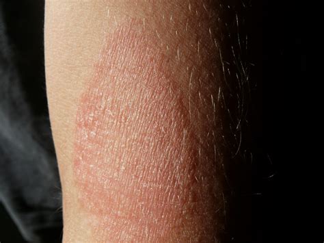 dermatite atopica cosa fare