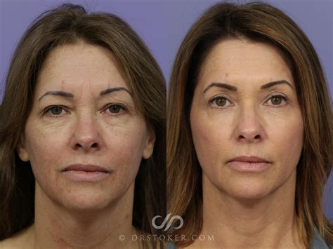 Laser Skin Resurfacing at Andrea Mcclelland blog