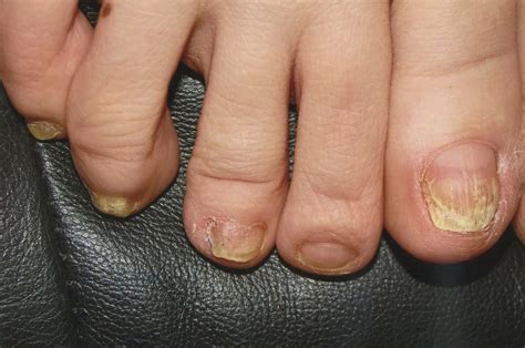 Toenail Fungus Before and After Photos - Advanced Podiatry of Manhasset ...