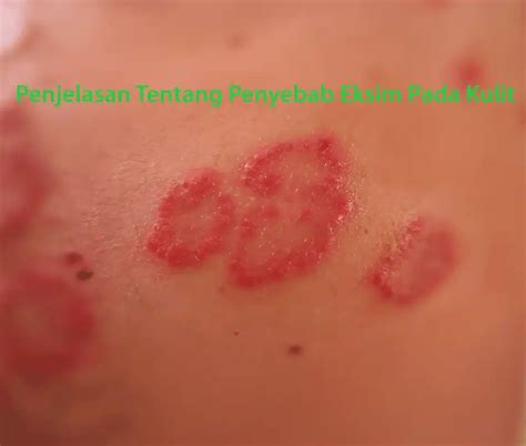 gejala eksim kulit  umum pt denature indonesia group