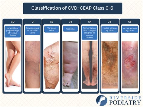 Chronic Venous Insufficiency (CVI) - Riverside Podiatry