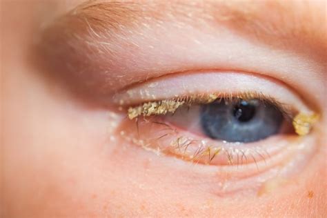 Conjunctivitis- symptoms, causes & treatment- Qoctor your online doctor