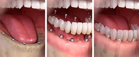 Full Mouth Dental Implants Treatment - Dr. Abhijit Deshpande