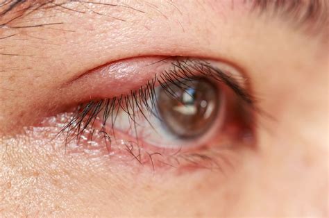 Espinha No Olho O Que Fazer - Terçol se assemelha a espinha perto dos olhos - Marcelo Creppe I ...