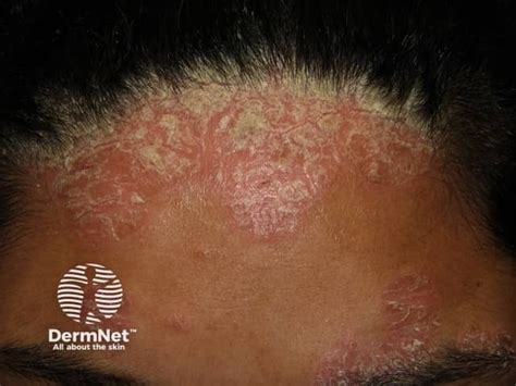 Scalp Psoriasis Images — DermNet