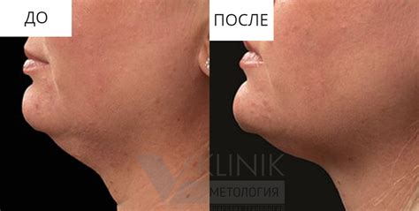 Криолиполиз - В Клиник, пространство красоты и здоровья - В-КЛИНИК
