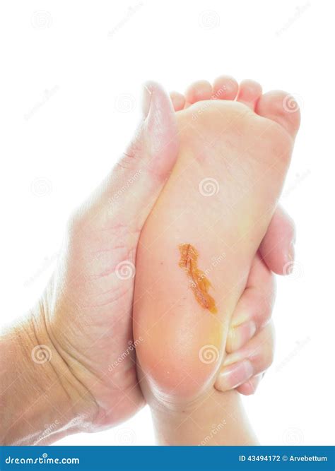 Child with a Long Cut Under Foot on Heel with Antiseptic, Being Stock