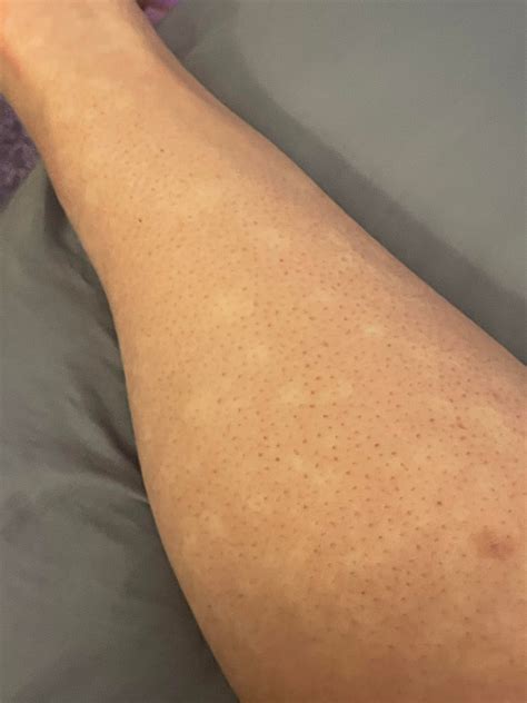 Why does my skin do this sometimes? Usually after a shower (warm or