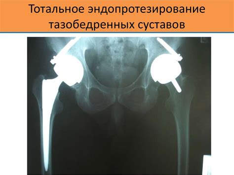 Принципы и современные методы лечения переломов. Несросшиеся переломы ...