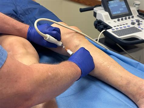 varithena treatment  cvva  results