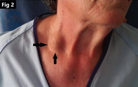 blood clot  jugular vein symptoms captions prince