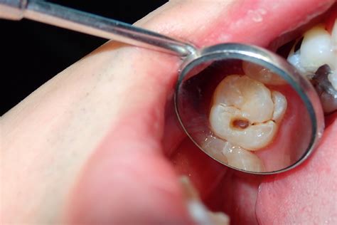 how to cure cavity naturally 5