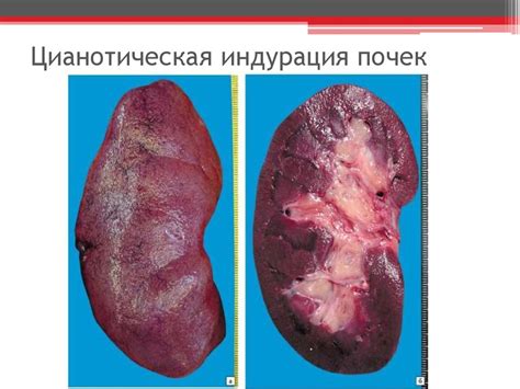 Венозная гиперемия - презентация онлайн