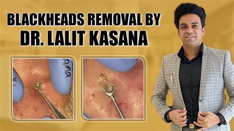 Unbelievable Blackhead Removal 2024: Get Ready for Flawless Skin - nymvwso