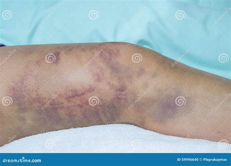 closeup   bruise  wounded woman leg stock photo image