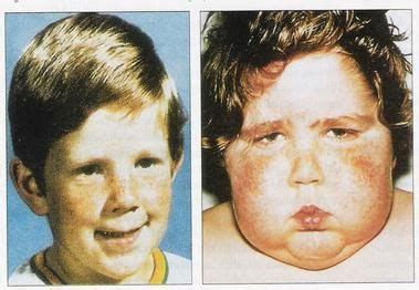 Moon facies in a patient with Cushing's syndrome | Cortisol, Tuyến yên ...