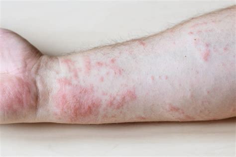 Zoom sur l’eczéma et le prurigo nodulaire - Association Française de l ...