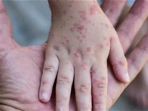 Monkeypox can be fatal for children: Expert