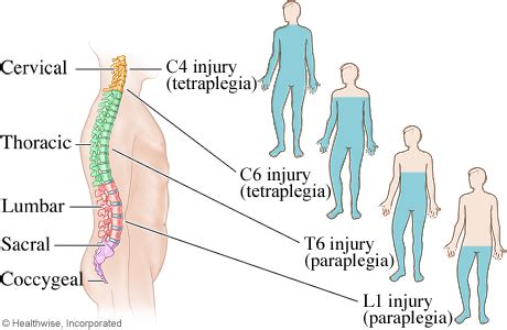 Paraplegia E Tetraplegia - Superação meu desafio: A diferença entre paraplegia e tetraplegia