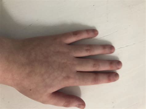 Anyone know why my hands are like this? : r/disease