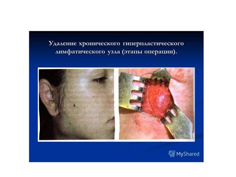 Лимфадениты челюстнолицевой области. Классификация. Клинические ...