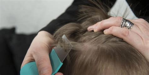 Liendres o caspa: no te confundas más y aplica un tratamiento