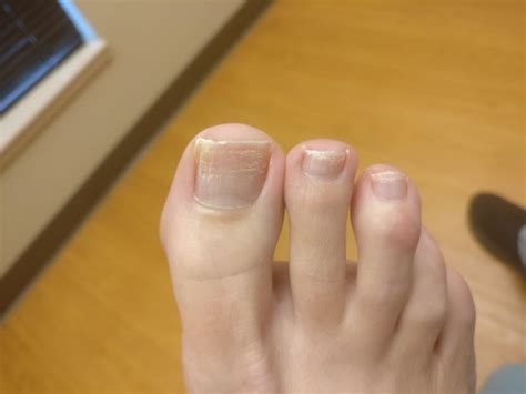 Discolored Toenails from Nail Polish [Causes, Signs & Best Treatment]