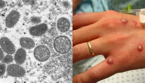 Variola Do Macaco Como Pega - Saiba como identificar as bolhas causadas pela varíola do macaco