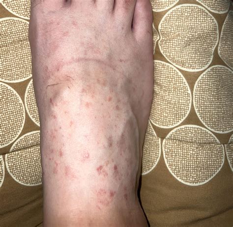 Derma diagnosed this as pityriasis rosea. Concerned that it could be something else? : r